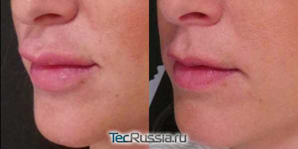 Структура лидазы