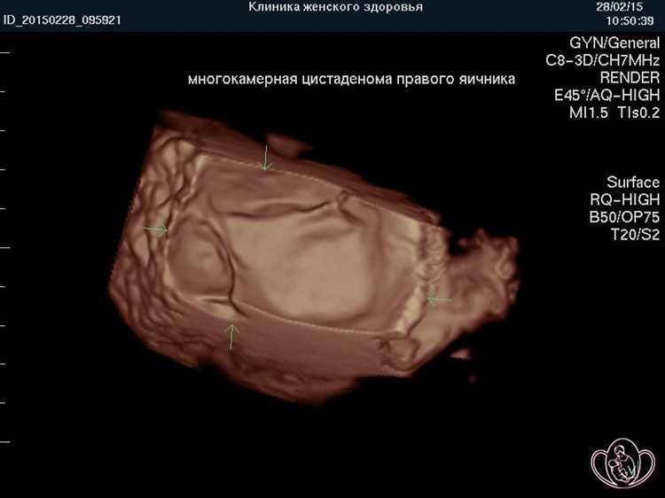 Чем отличается тератома от дермоидной кисты: основные различия и признаки