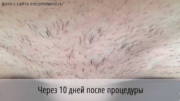 Процесс эпиляции волос: как это работает?