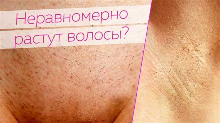 Почему волосы начинают расти после эпиляции: научное объяснение