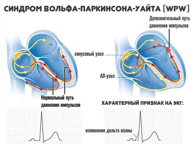 Причины возникновения синдрома ВПВ: