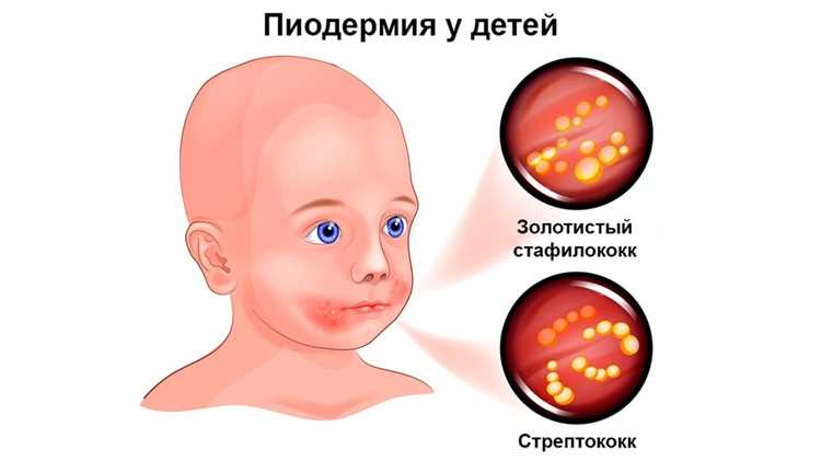 Методы лечения стрептодермии и импетиго