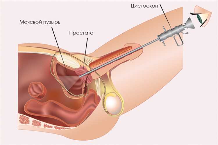 Цистография и цистоскопия: различия и особенности